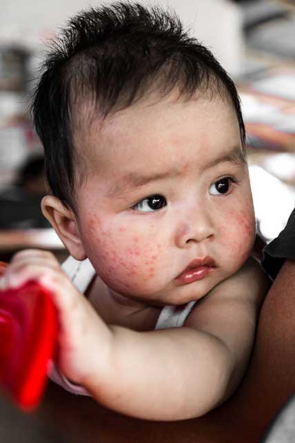 Kenali Dermatitis Atopik pada Bayi