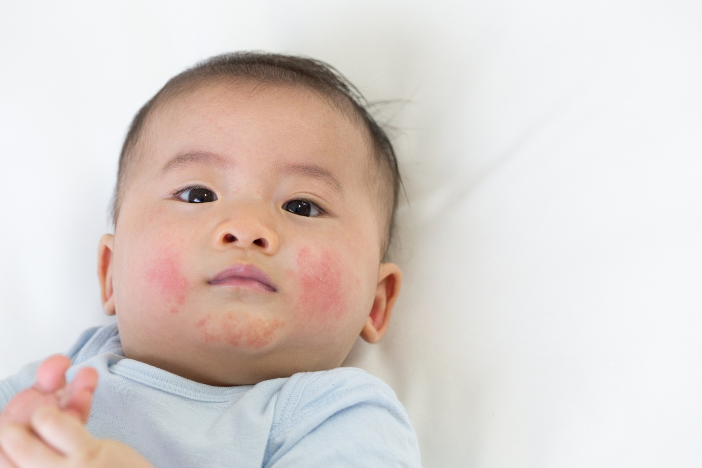 Cara Mencegah dan penyebab Ruam Susu pada Bayi